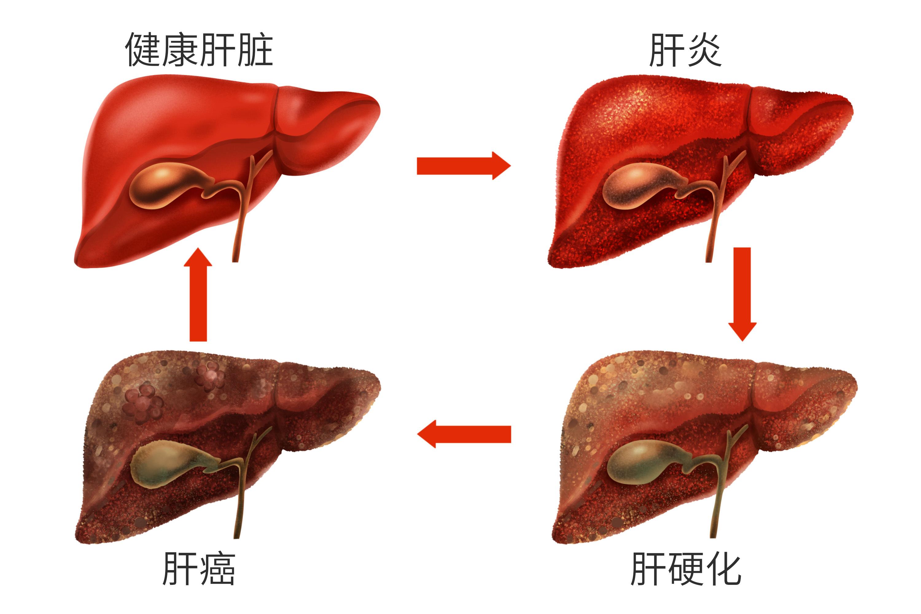 乙肝和正常人的肝图片图片