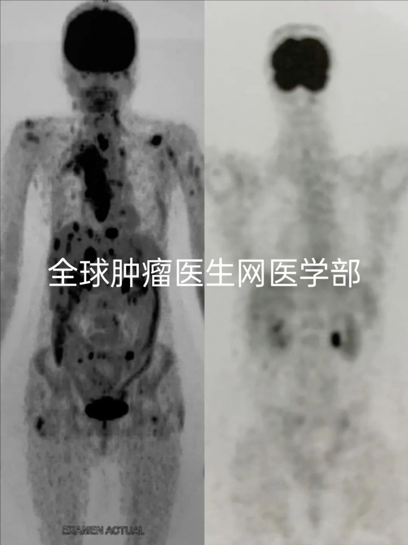 仅8周全身肿瘤奇迹消失​!革命性抗癌药再次创下重生神话