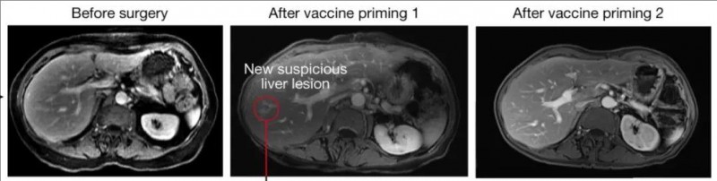 自体cevumeran疫苗治疗胰腺癌的效果