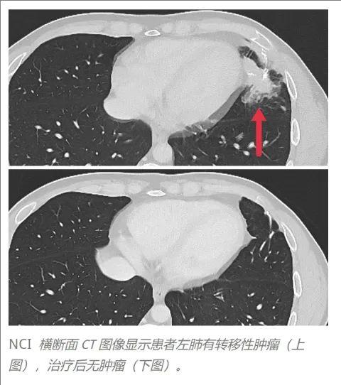 TCRT细胞疗法治疗结直肠癌肺转移的效果