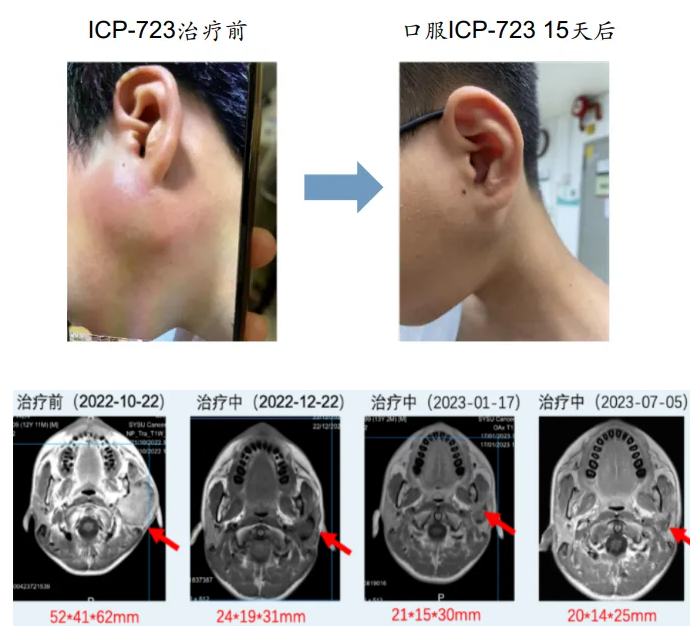 ICP-723治疗涎腺癌的效果