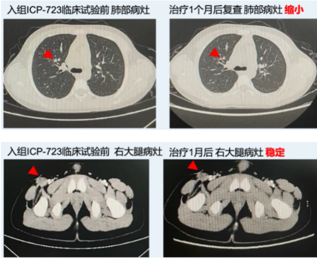 ICP-723治疗1代NTRK抑制剂耐药的软组织恶性梭形细胞瘤伴肺转移的效果