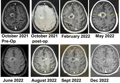 DOC1201疫苗治疗胰腺癌的效果