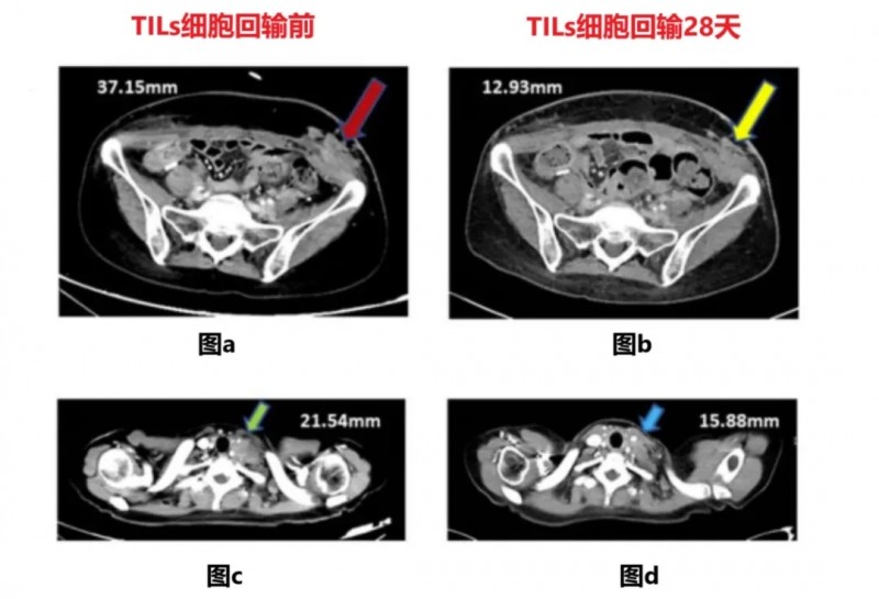 GT101治疗晚期宫颈癌的效果