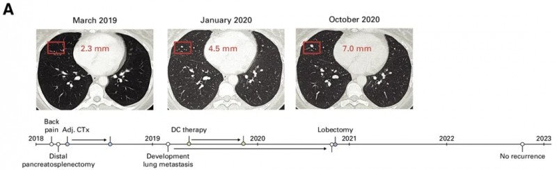 树突疫苗治疗胰腺癌的效果