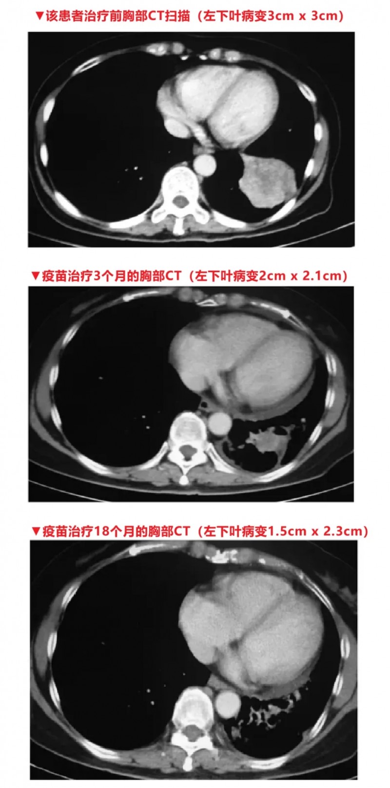 古巴肺癌疫苗治疗肺癌的效果
