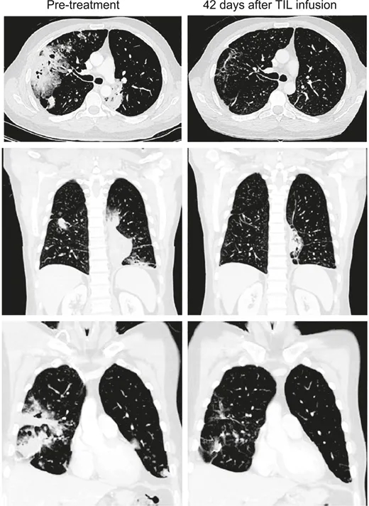癌症探索杂志报道TIL细胞疗法治疗肺腺癌的效果