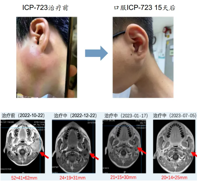 ICP-723治疗涎腺源性肿瘤的效果