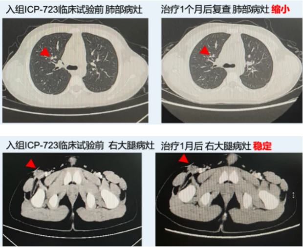ICP-723治疗软组织恶性索性细胞肿瘤伴肺转移的效果