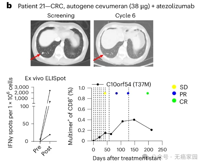 cevumeran疫苗联合atezolizumab治疗直肠癌的效果数据