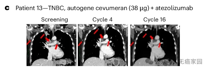 cevumeran疫苗和atezolizumab治疗三阴型乳腺癌的效果