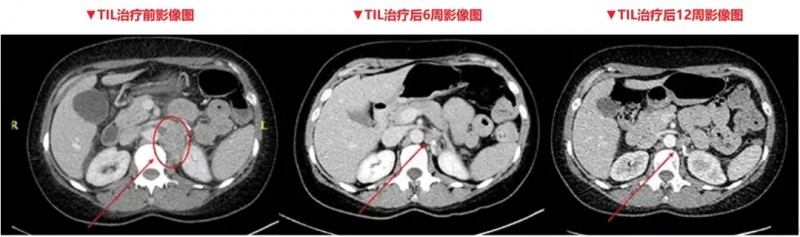 TIL细胞疗法治疗效果