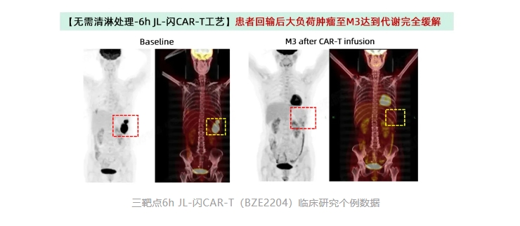 重大进展|上海细胞治疗集团JL-闪CAR-T平台全球首次在无化疗清淋方案情况下实现难治性淋巴瘤患者1