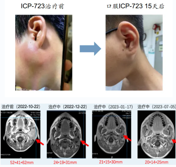 ICP723治疗涎腺癌的效果