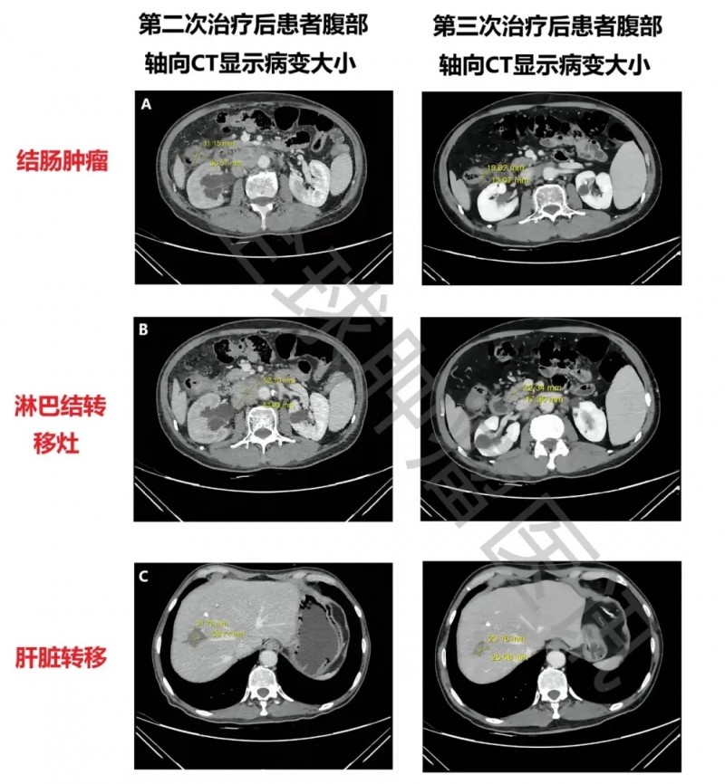 肠道菌群治疗肠癌的效果