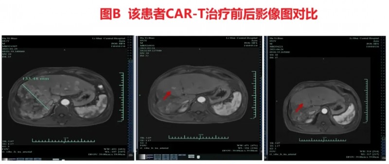 GPC3 CAR-T细胞治疗肝癌的效果