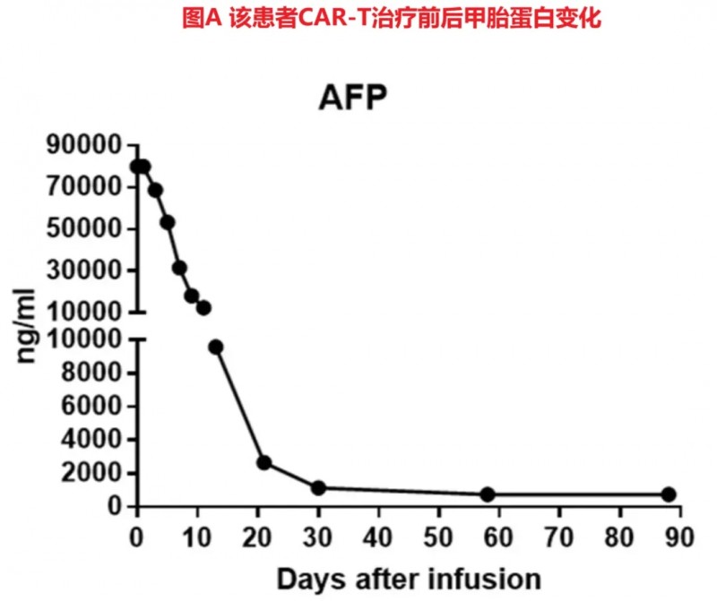 GPC3 CAR-T细胞治疗肝癌甲胎蛋白的数据
