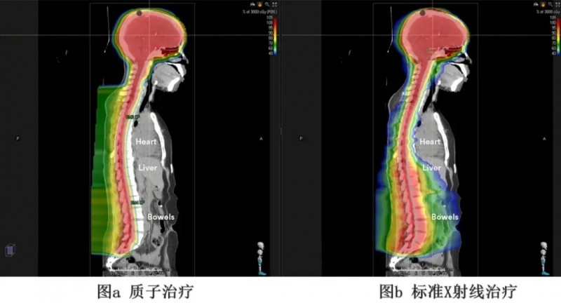 治疗头部和脊柱质子治疗和X射线治疗的对比
