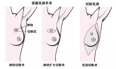 乳癌手术选保乳还是全切?一次讲明白,兼顾疗效与生活质量,帮你找到最优解