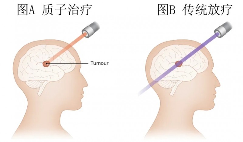 质子治疗和传统放疗对比