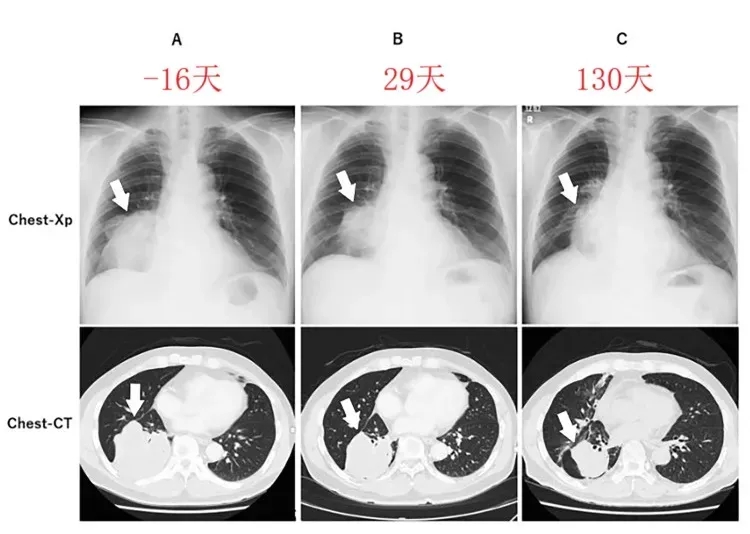 WT1-DC疫苗治疗肺腺癌的效果