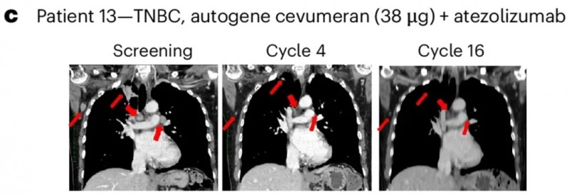 cevumeran疫苗治疗三阴性乳腺癌的效果