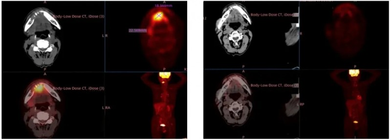 GT201治疗头颈部鳞癌的效果