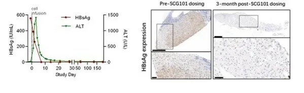 SCG101 TCR-T治疗肝癌的HBV感染改善数据