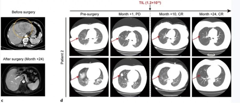 三联TIL细胞疗法治疗晚期肝癌的效果