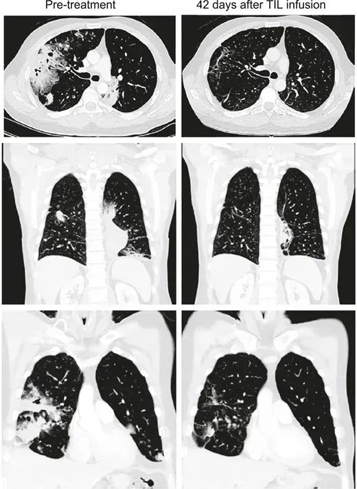 TIL细胞疗法治疗黑色素瘤的效果