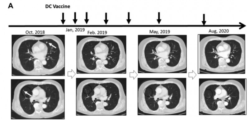 转移灶消失了!新抗原肽DC疫苗对多癌种显效,癌症治疗再添新利器