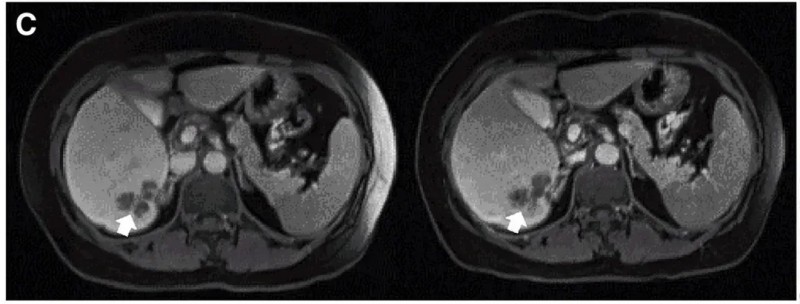 CEA CART细胞疗法治疗结直肠癌的效果