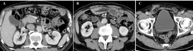 DC疫苗联合CAT治疗十二指肠癌腹水水肿的效果