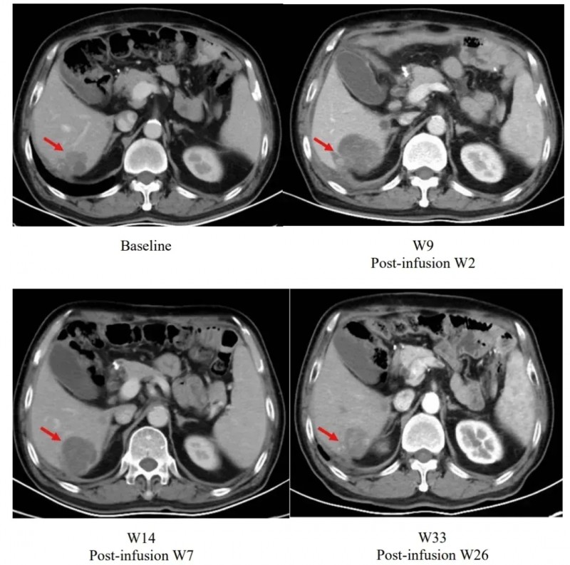舒瑞基奥伦塞治疗效果