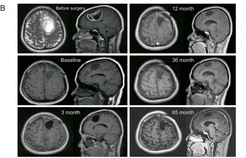 DC疫苗联合免疫疗法治疗胶质母细胞瘤的效果