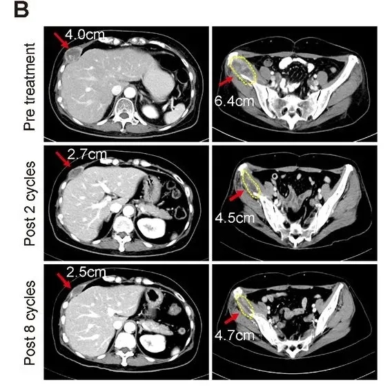 NK细胞联合曲妥珠单抗治疗乳腺癌的效果