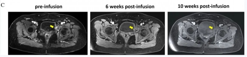 TIL细胞联合PD-1治疗复发性宫颈癌的效果