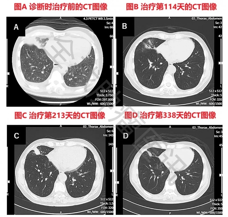 WT1-DC疫苗治疗晚期肺癌的效果