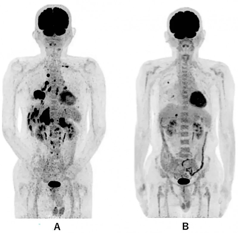WT1-DC联合化疗治疗晚期肺癌的效果