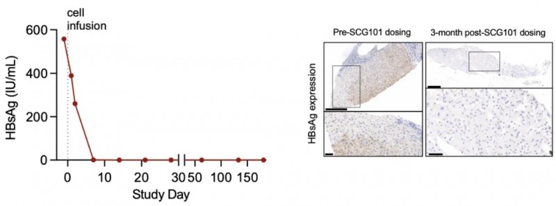 SCG101治疗肝癌免疫组化的变化