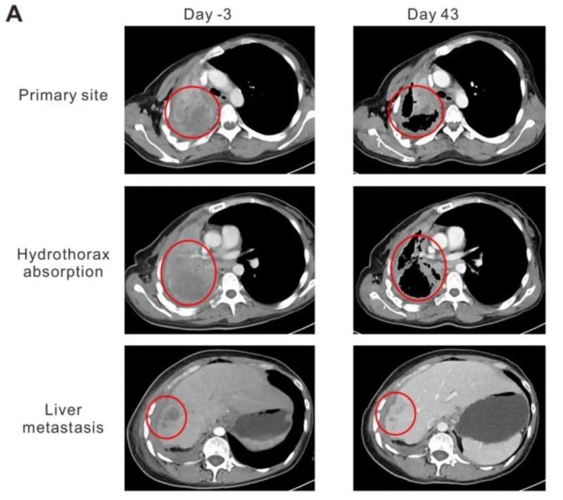 NY-ESO-1 TCR-T治疗晚期肺癌的效果