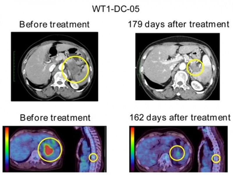 WT1-DC疫苗治疗胰腺癌的效果