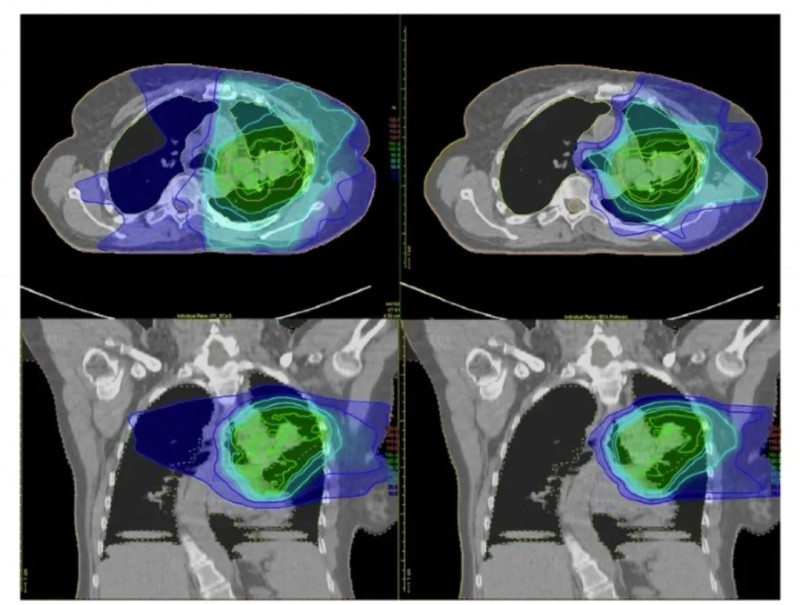 质子治疗肺癌的辐射范围