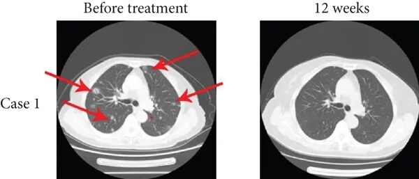 TIL细胞疗法联合PD-1治疗骨肉瘤肺转移12周的效果