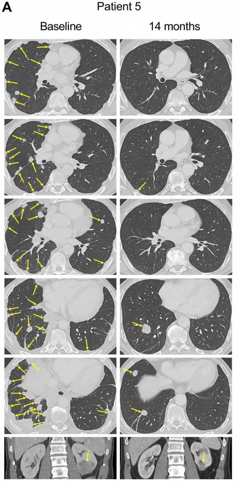 E7 TCR-T疗法治疗HPV阳性的转移性肛门癌的效果