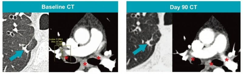 A2B694 CAR-T治疗KRAS双突变肺癌的效果