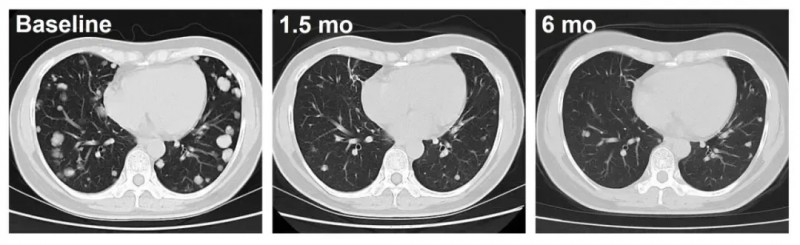 C-CAR031治疗肝癌的效果