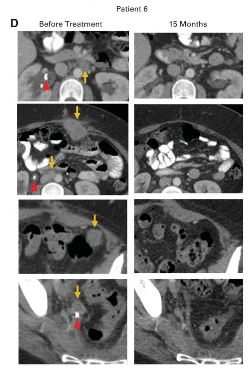 HPV-TIL细胞疗法治疗宫颈癌的案例