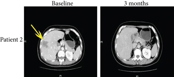 TIL细胞疗法联合PD-1治疗宫颈癌肝转移的效果