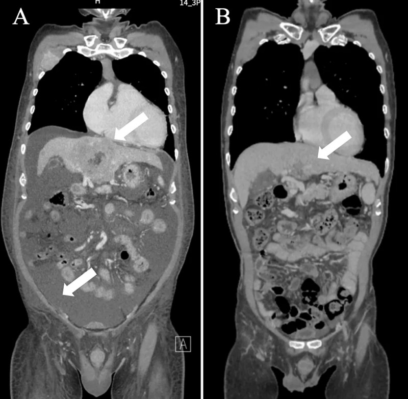 未治疗的肝癌CT扫描